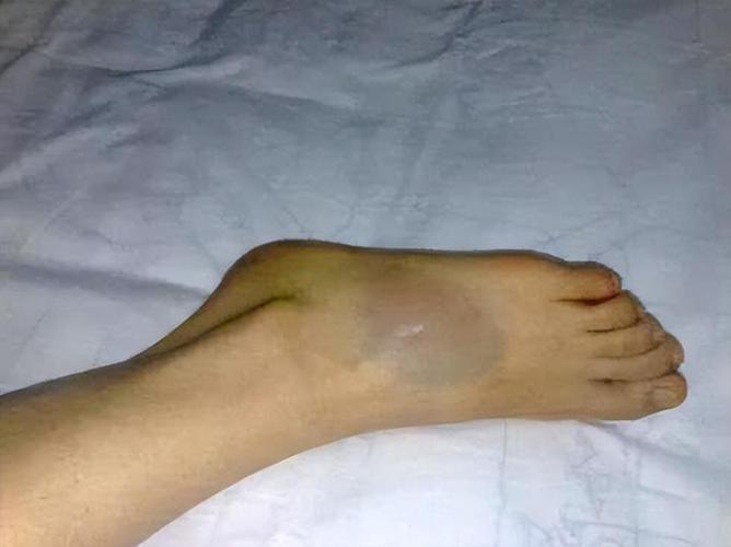 🔎莱昂纳德受伤瞬间：踩到拉松鞋面失衡 致脚踝90°严重扭伤